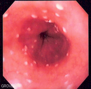 Esophageal_candidiasis